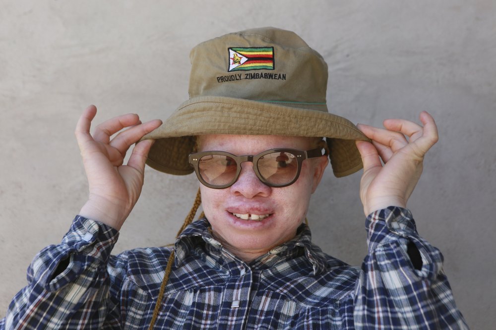 In Zimbabwe, people with albinism struggle against prejudice