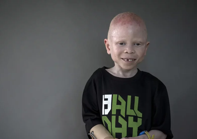 “We are no different”: An awareness campaign in Zimbabwe sheds light on life with albinism