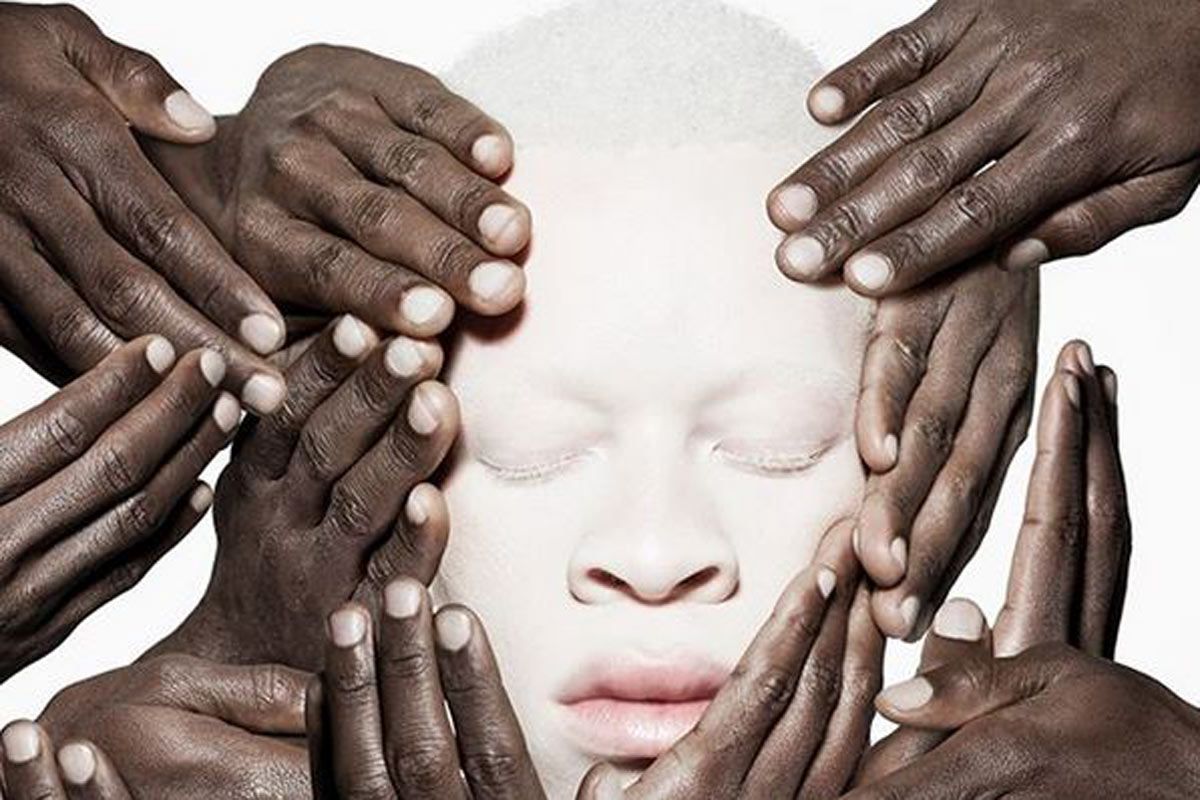 International Albinism Awareness Day 2023